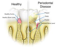 treating periodontal disease